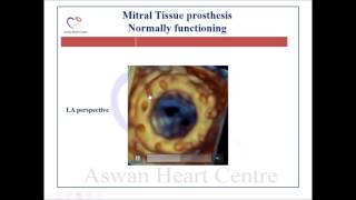 3DTEE of Mitral valve prostheses [upl. by Verina578]