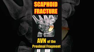 Fracture of the Scaphoid with Avascular Necrosis radiology doctor trauma [upl. by Hayidah239]