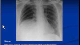 Chest xray interpretation Raised hemidiaphragm [upl. by Atikcir]