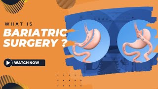 What is Bariatric Surgery [upl. by Elleynod]