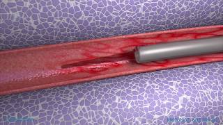 Peripheral IV Phlebitis Animation [upl. by Anilave]