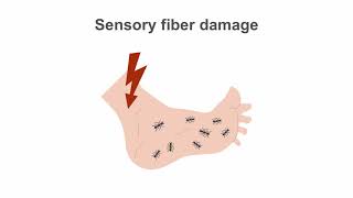 Diabetic Neuropathy Advanced Management Techniques [upl. by Odilia653]