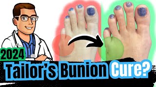 Bunionette Tailors Bunion Surgery Corrector Splints amp Treatment [upl. by Carlota]