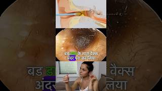 Wax nikalne ke liye Kya ear buds sahi hai  earwax earwaxremoval [upl. by Asiral431]