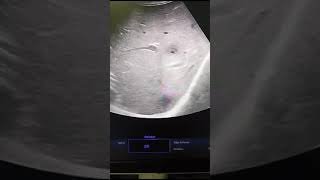 Early Liver Abscess [upl. by Zeta]