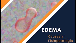 EDEMAS CAUSAS Y FISIOPATOLOGÍA [upl. by Elamef882]