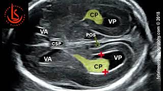 Fetal lateral ventricle measurements How to measure posterior ventricle for ventriculomegaly [upl. by Pirzada]