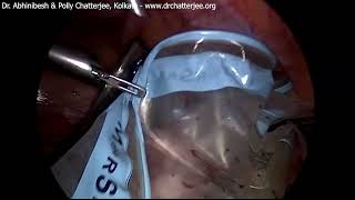 Laparoscopic fundal pedunculated subserous myomectomy  in bag morcellation [upl. by Welcome242]