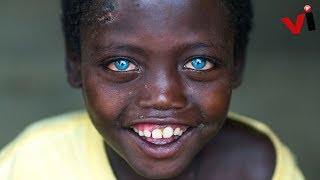 5 Stunning People With Waardenburg Syndrome [upl. by Adnalra]