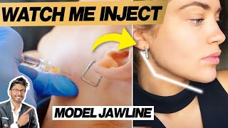 Jaw Filler Before amp After With Procedure  Technique Needle [upl. by Seys]