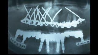 How do dental implants work What was the beginning of dental implantology [upl. by Chelsie]