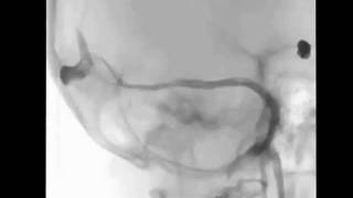 coiling aneurysm and transversus sinus angioplasty [upl. by Nylhtiak482]