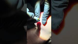 The Electrolysis Expert Permanent Haier Removal Session [upl. by Quintin685]