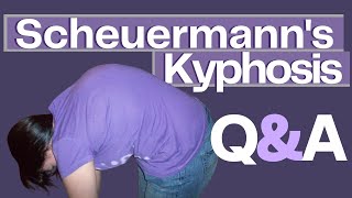 Common Questions About Scheuermanns Kyphosis [upl. by Ssur48]