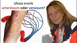 Was ist der Unterschied zwischen einem ulcus cruris arteriosum und venosum [upl. by Airdua]