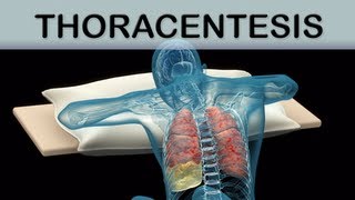 Thoracentesis Medical Animation [upl. by Lorette]