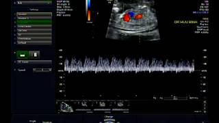 Ductus venosus Doppler [upl. by Leumas]