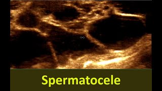 Spermatocele  Sonographic Prediction of Spermatocele  Epidydimal cyst [upl. by Adyela69]