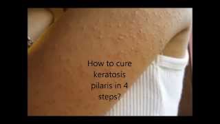 How to cure keratosis pilaris in 4 easy steps [upl. by Draner872]