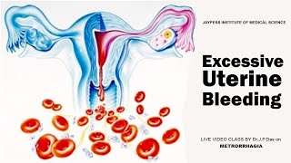 Excessive Uterine Bleeding  Jaypess Institute of Medical Science  Silchar [upl. by Runkel]