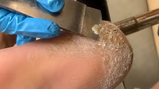 Callus removal from feetampFoot scraping dead skin【Xiao Yan pedicure】stress 617 [upl. by Yessac]