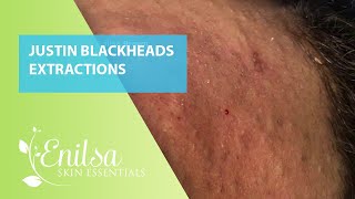 Justin Blackheads Extractions 4th Treatment Part 1 [upl. by Cleopatre]