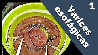 🚨Manejo endoscópico de VARICES ESOFÁGICAS 🚀Curso de ENDOSCOPIA TERAPÉUTICA 1 [upl. by Gannes]