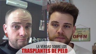 LA VERDAD SOBRE LOS TRASPLANTES DE PELO [upl. by Lyall]