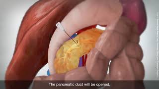 Longitudinal pancreaticojejunostomy Puestow procedure [upl. by Tilla]