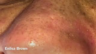 Blackheads Extractions and Acne Treatment on Daryl [upl. by Nea39]