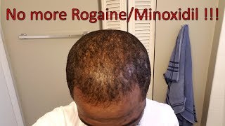 No more rogaineMinoxidil  Week1 [upl. by Maiah]