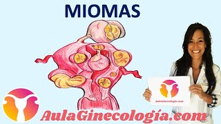 MIOMAS Síntomas diagnóstico y tratamiento de los miomas  Ginecología y Obstetricia [upl. by Horsey648]