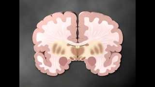 Parkinsons part 1 of 2  Medical Animation by Watermark [upl. by Heinrick43]