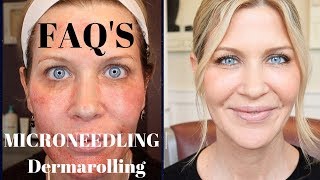 Microneedling  Dermarolling QampA  Before During and After Pics [upl. by Enelyw963]