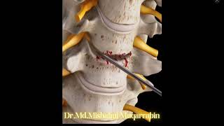 Anterior Cervical Discectomy and FusionACDF [upl. by Edalb244]