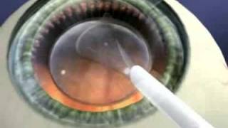 Staar Surgical Visian ICL Implantation [upl. by Dleifniw]