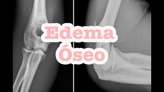 Edema oseo 😣 en mano🖐  Sugerencias en casa [upl. by Leanahtan607]