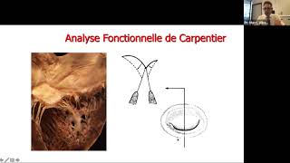 M RADERMECKER Rech transversale s la dégénérescence myxoïde de la valve mitrale amp chirurgie [upl. by Hooge]