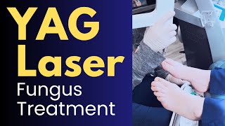 YAG Laser Treatment for Toenail Fungus Nd YAG Laser Before and After [upl. by Nnaed]