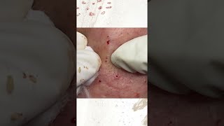 Big Cystic Acne Blackheads Extraction Blackheads amp Milia Whiteheads Removal Pimple Popping [upl. by Eruza]