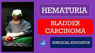 BLADDER CARCINOMA How To DIAGNOSE amp TREAT  HEMATURIA [upl. by Stier819]