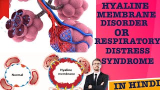 HYALINE MEMBRANE DISORDER OR RESPIRATORY DISTRESS SYNDROME what happened in alveoli let’s see [upl. by Adorl]