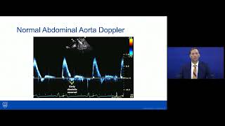 Coarctation of the AortaImaging and Management [upl. by Luhem]