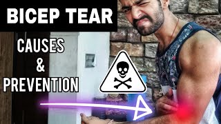 Bicep Tendon Tear  Causes amp Prevention HINDI [upl. by Durman94]