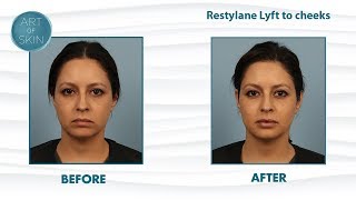 Restylane Lyft Perlane filler for cheek lifting and facial balancing [upl. by Mullins]