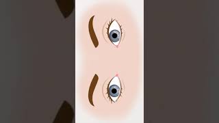 Animation of Horizontal Nystagmus seen in BPPV [upl. by Beard239]