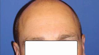 Hair restoration for balding frontal area [upl. by Aikat]