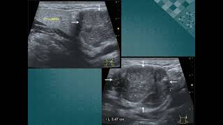 Mucoepidermoid carcinoma 점액표피양 암종침샘암 [upl. by Lietman]