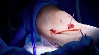 MCL Reconstruction Surgery [upl. by Janel]