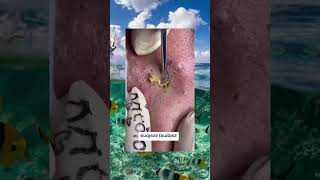 Blackheads Removal  Acne Treatment and Very Satisfying Satisfying Pimple pop blackheads [upl. by Hadik]